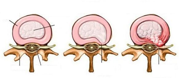 medzistavková prietrž s cervikálnou osteochondrózou